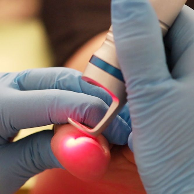 Tratamientos con Laser